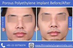 Porous-Polyethylene-Implant-2
