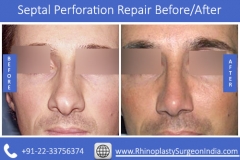 Septal-Perforation-Repair-4