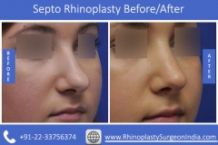 Septo-Rhinoplasty-4