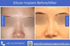 Silicon-Implant-3
