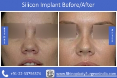 Silicon-Implant-2