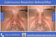 Submucous-Resection-2