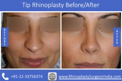 Tip-Rhinoplasty-2