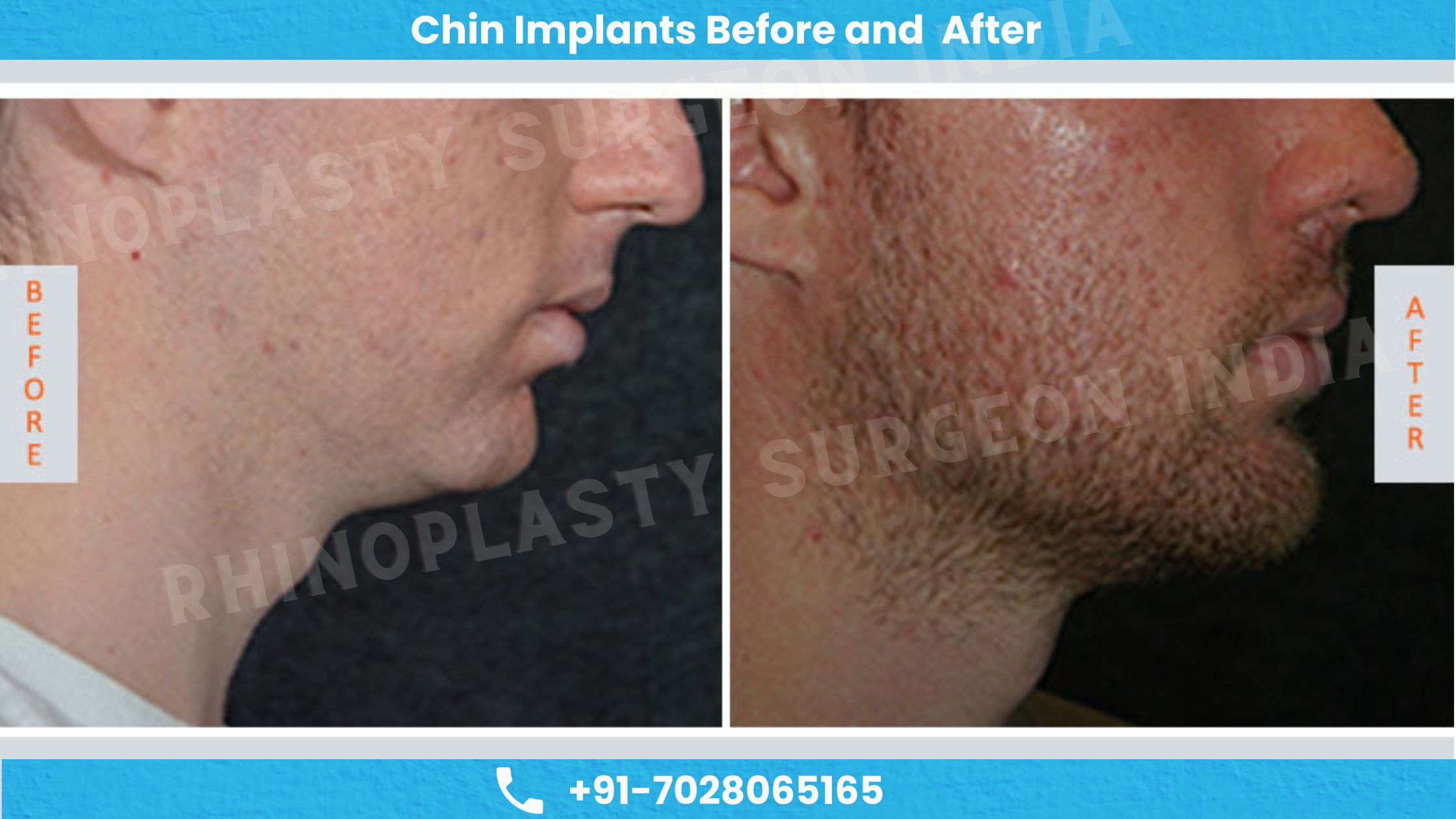 Before and after images of chin implants
