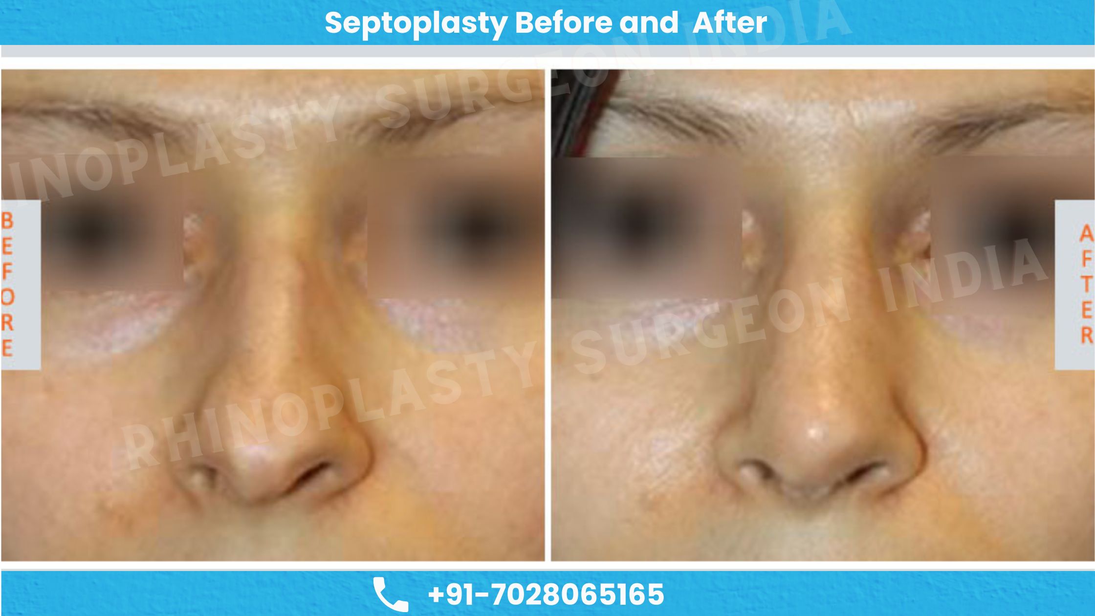 Before and after images of septoplasty surgery