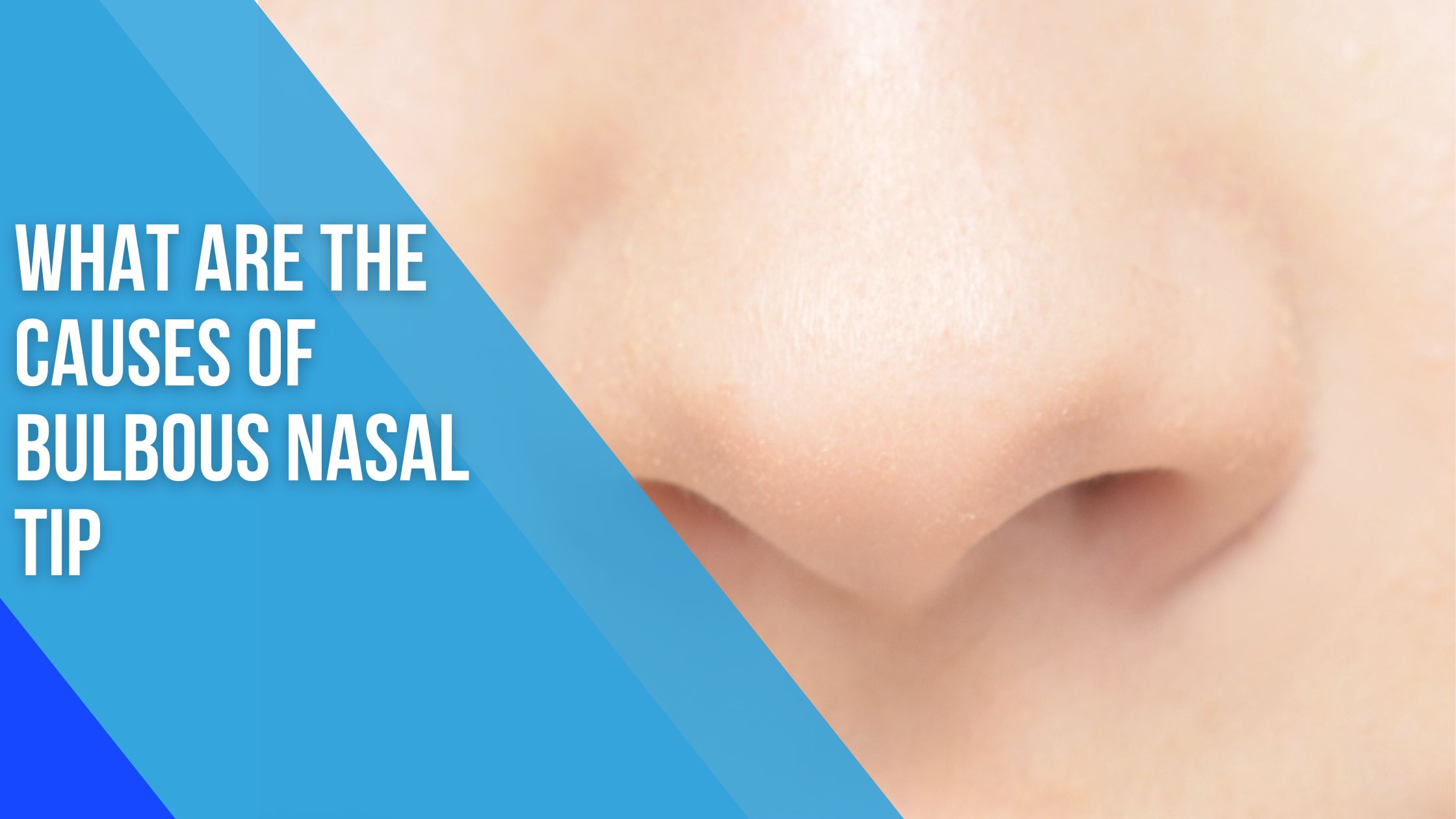 what are the Causes of Bulbous Nasal Tip 