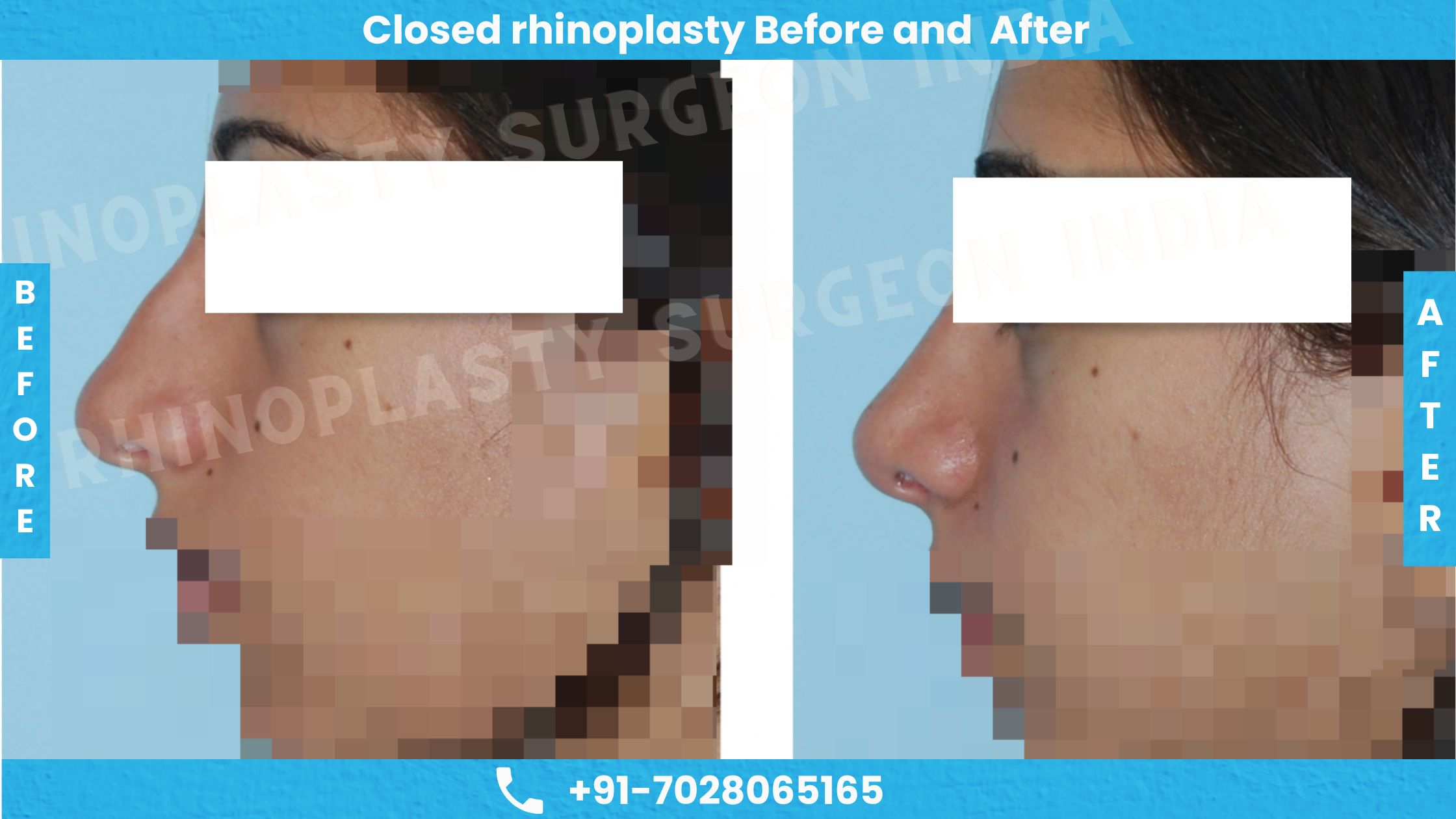 Before and After photos of Closed Rhinoplasty treatment 