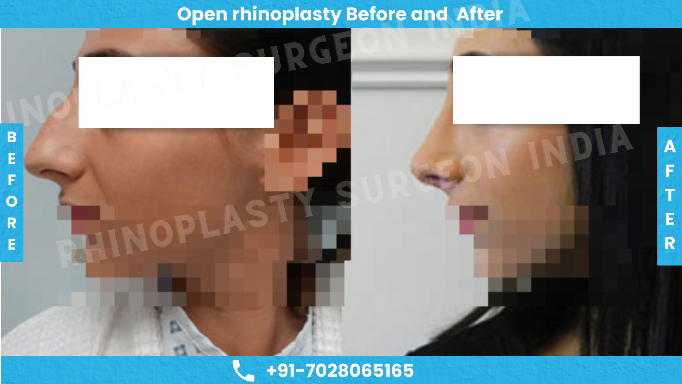 Before and After Photos of Open Rhinoplasty
