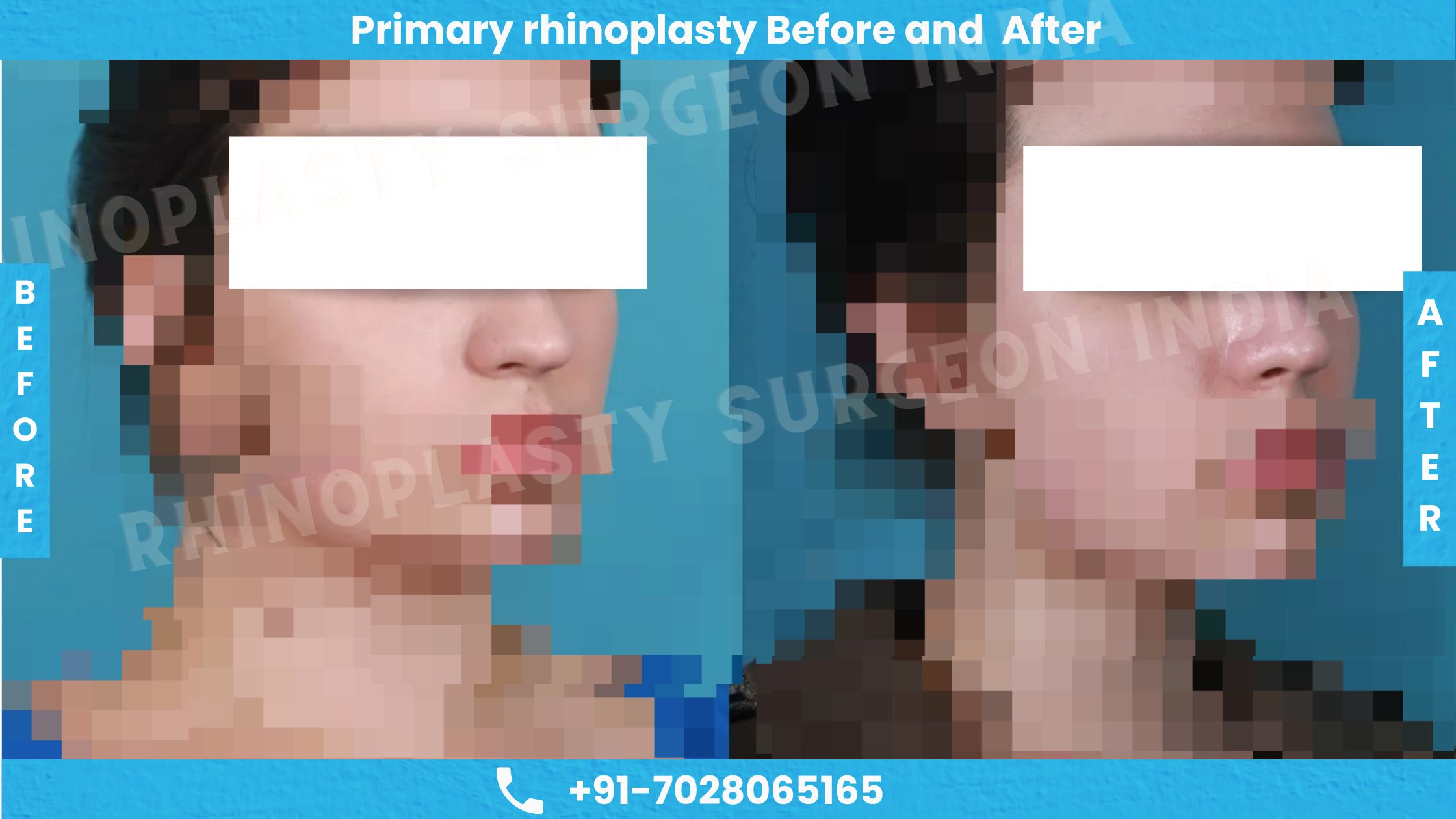 Before and After photos of primary Rhinoplasty