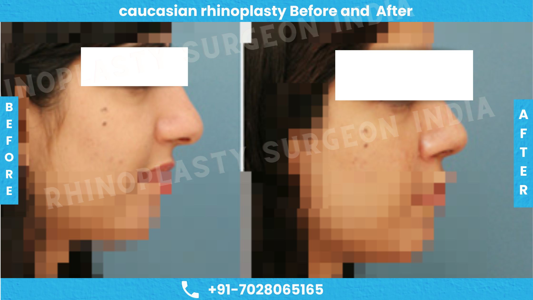 Before and After Photos of Caucasian Rhinoplasty Treatment-