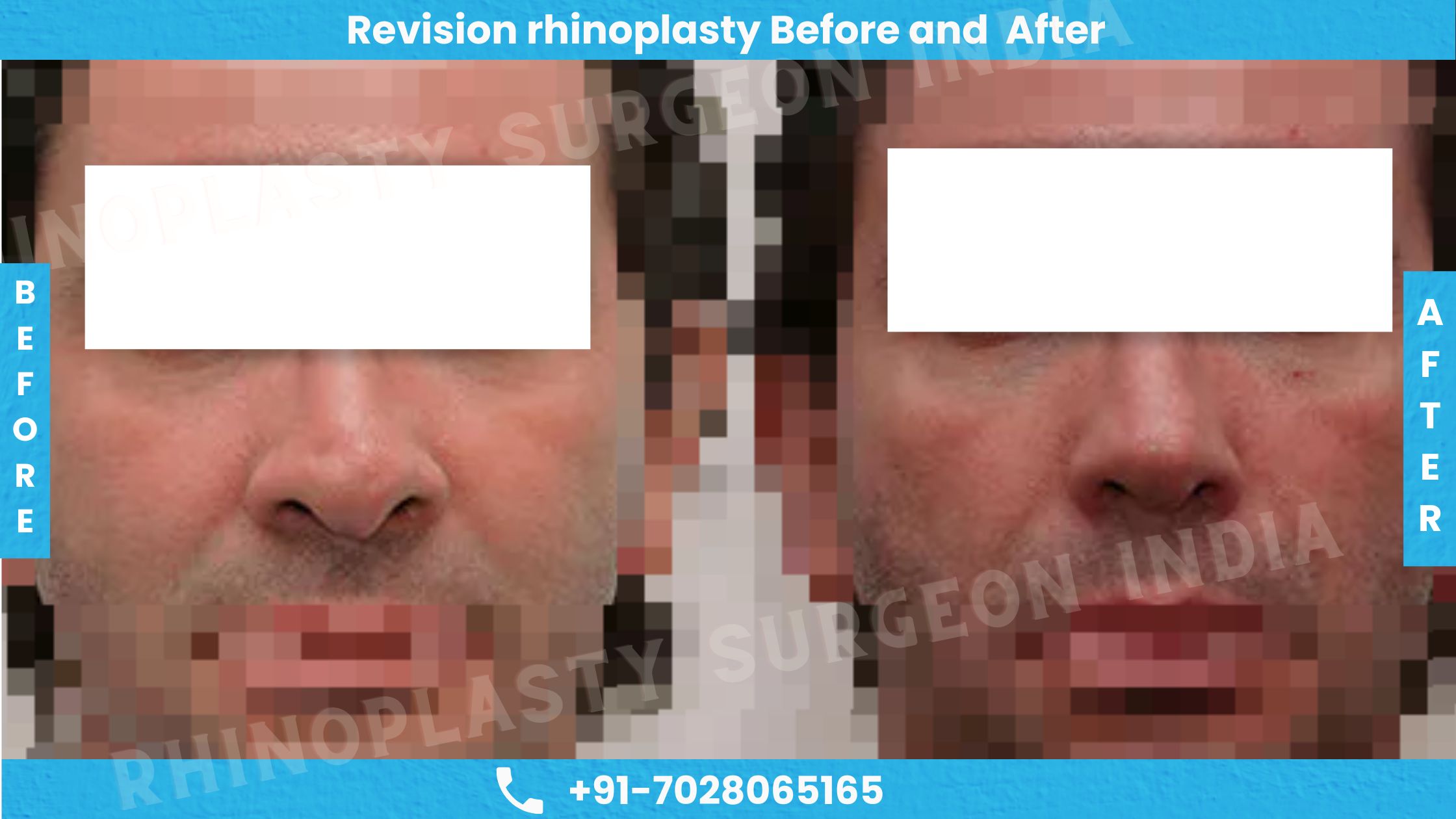 Before and After Photos of rivision Rhinoplasty