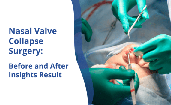 Nasal Valve Collapse Surgery